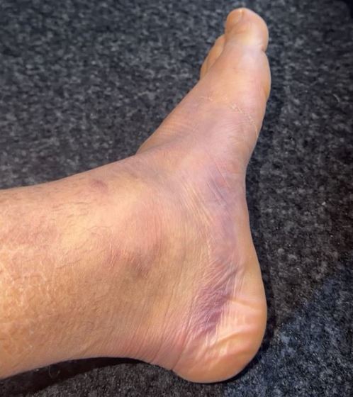 Xavi Simons jugó los 90 minutos contra Dortmund a pesar de tener problemas con un tobillo muy inflamado